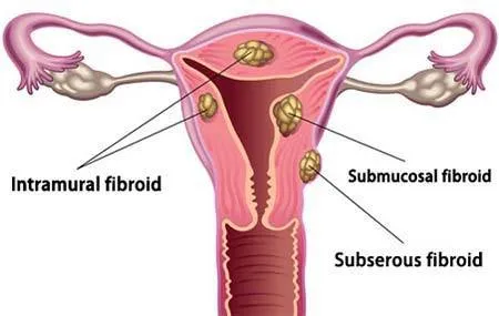 Uterine Fibroids